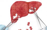 Liver Cancer Causes