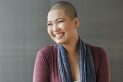 Ovarian Cancer and Hair Loss