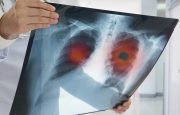 An x-ray of a patient's lungs