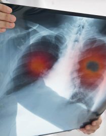 Understanding the Stages of Lung Cancer Understanding the Stages of Lung Cancer