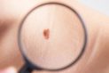 Skin Cancer Symptoms
