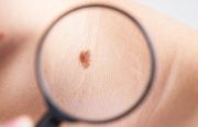 Skin Cancer Symptoms