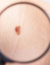 Four Symptoms of Skin Cancer to Be Aware Of Four Symptoms of Skin Cancer to Be Aware Of