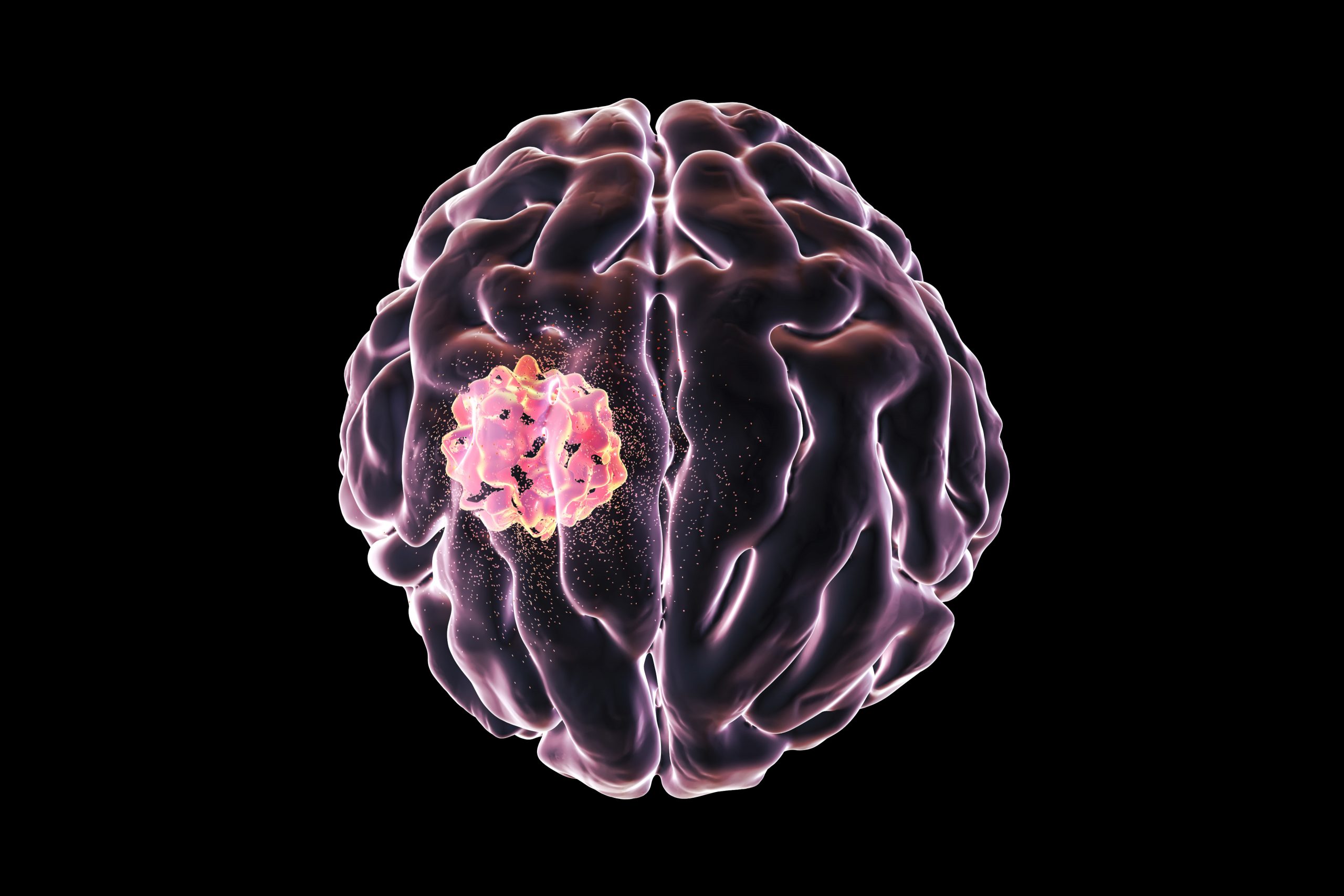 Brain Cancer Types What Are The Most Common Forms Of Brain Cancer 